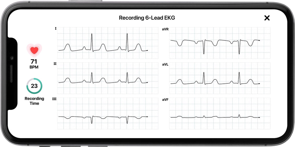 2026 KardiaMobile 6L Moniteur ECG personnel pour smartphones